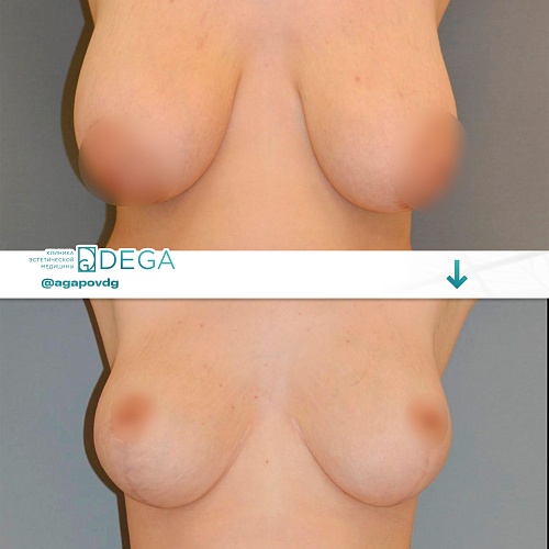 Reduction mammoplasty (breast reduction)