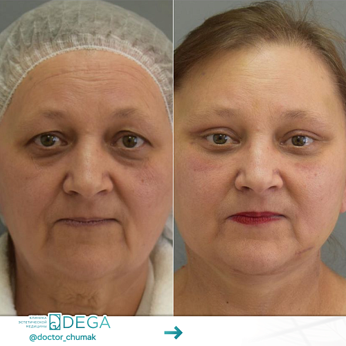 Facial and neck plastic surgeries