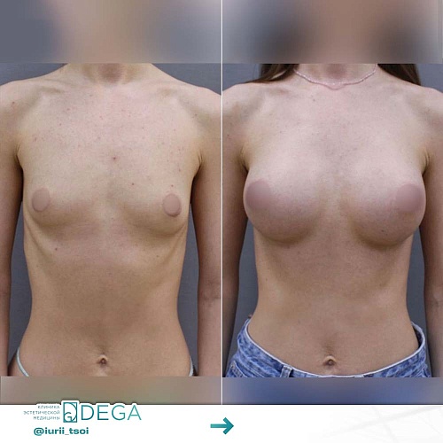 Breast augmentation surgeries
