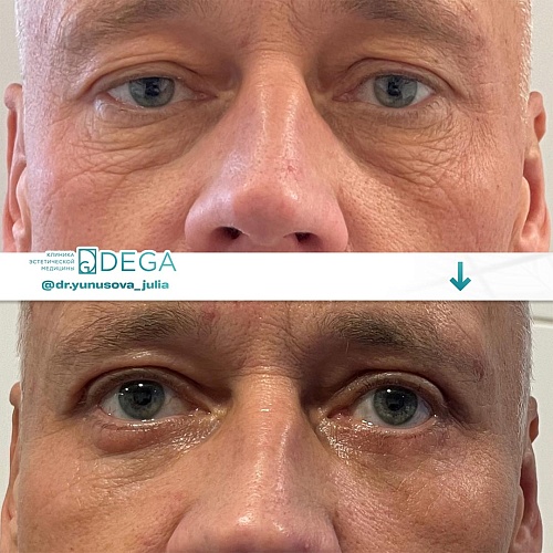 Upper eyelid blepharoplasty