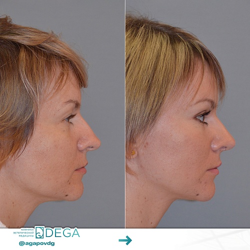 Tip of the nose plasty