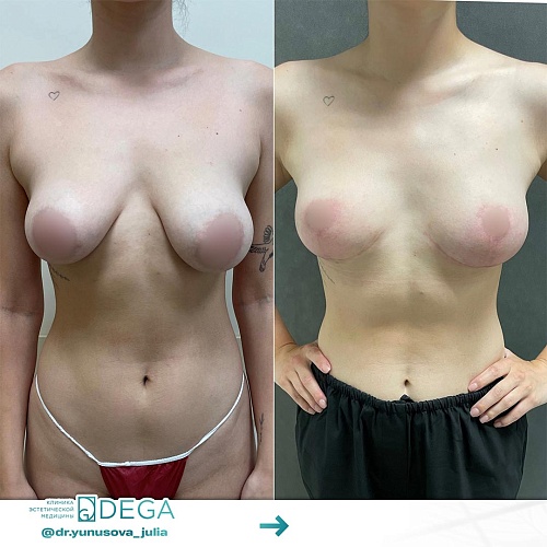 Mastopex (breast lift)