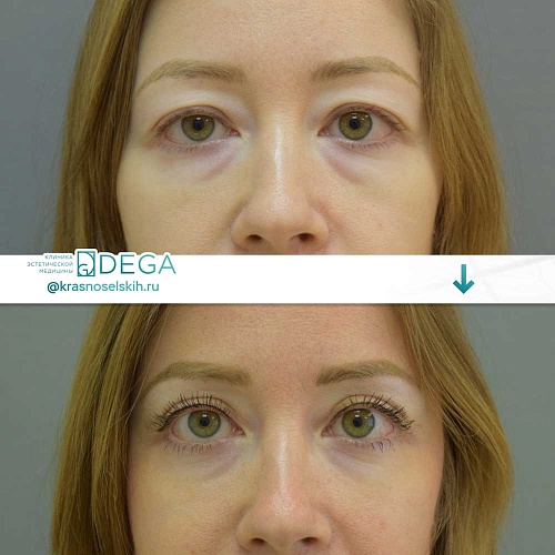 Blepharoplasty (eyelid surgery)