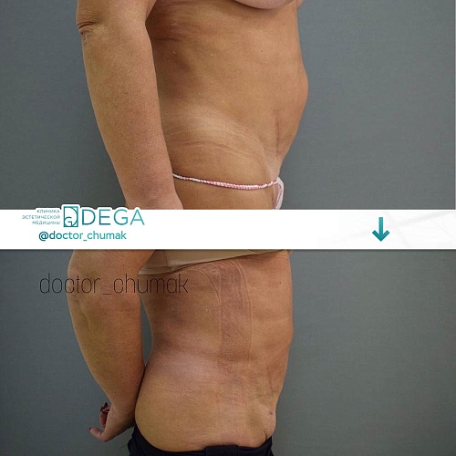 Body liposuction