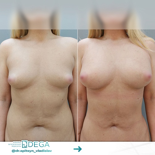 Breast augmentation surgeries