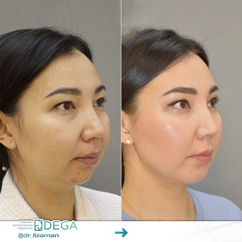 Chin plastic surgery (mentoplasty, genioplasty)