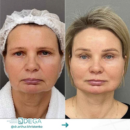 Chin plastic surgery (mentoplasty, genioplasty)