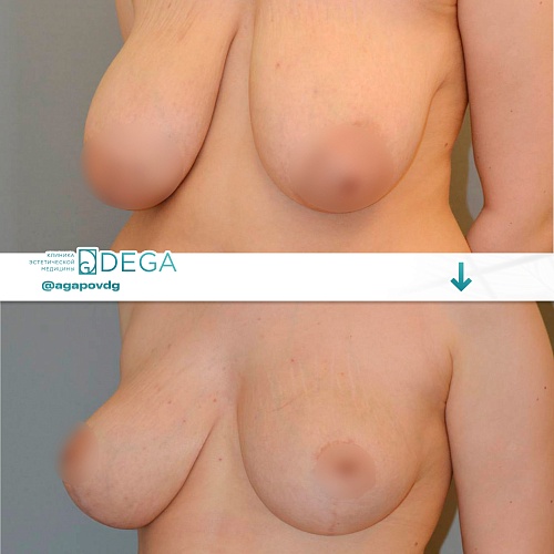 Reduction mammoplasty (breast reduction)