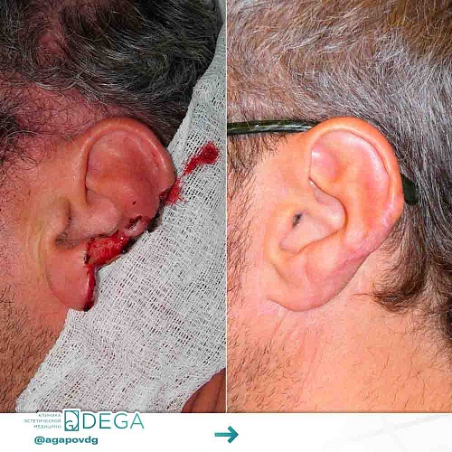 Optoplastics (ear correction)