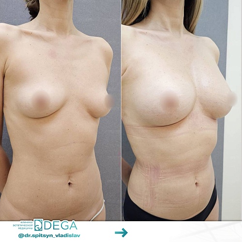 Lipofilling of the breasts