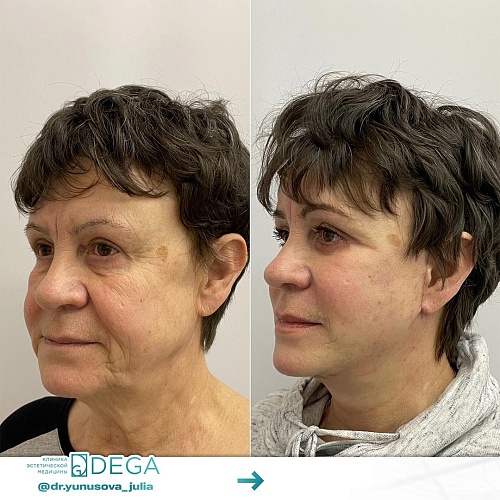 Lower face and neck lift